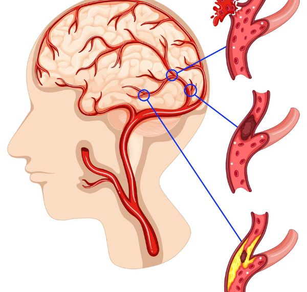 aneurysm clipping & coiling