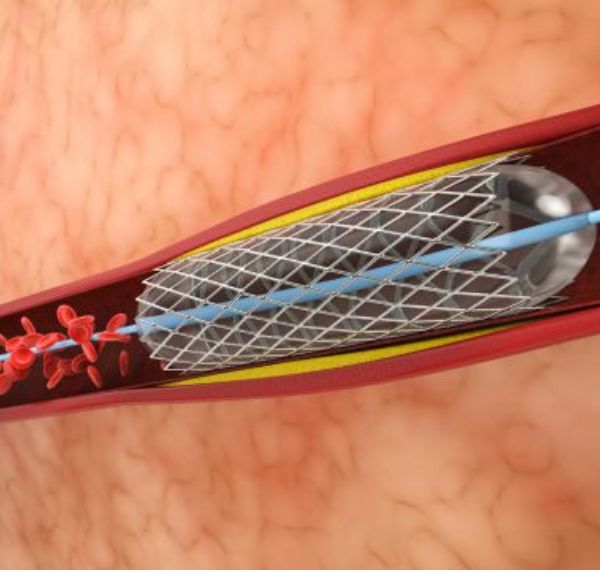 angioplasty