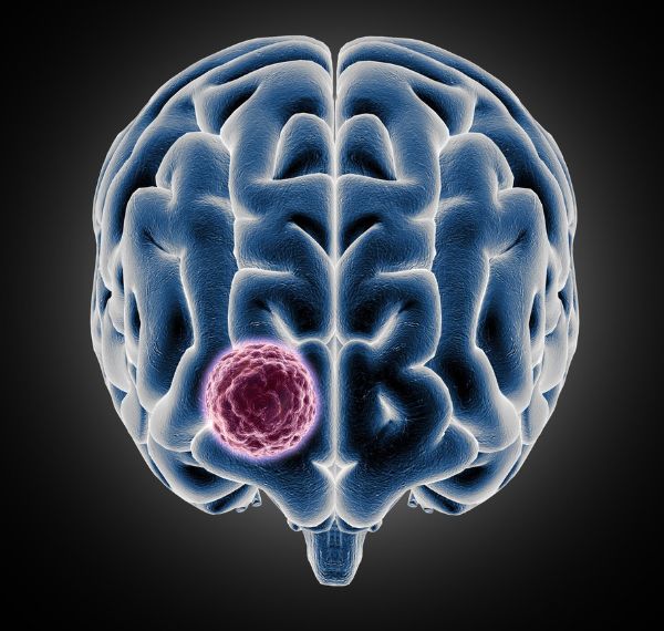 brain tumor surgery