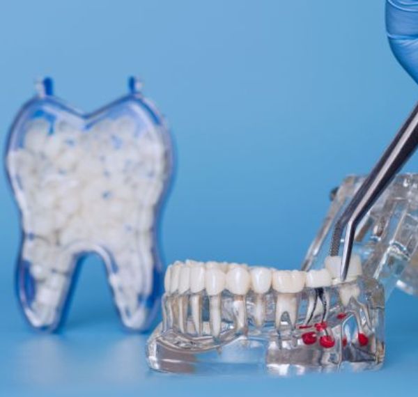 dental crowns & bridges