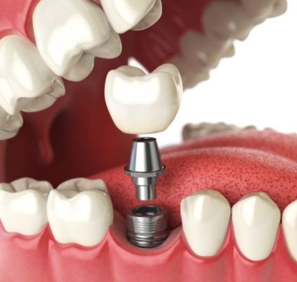 dental implants