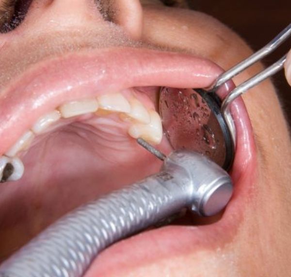 full mouth rehabilitation