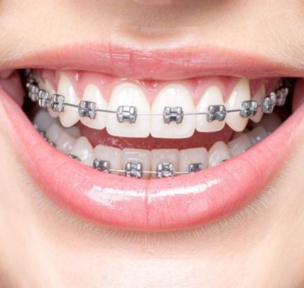 orthodontic treatment (braces & aligners)