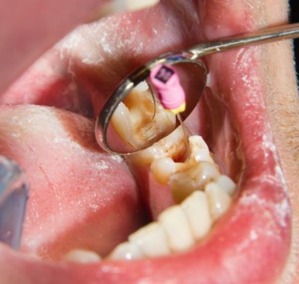 root canal treatment (rct)
